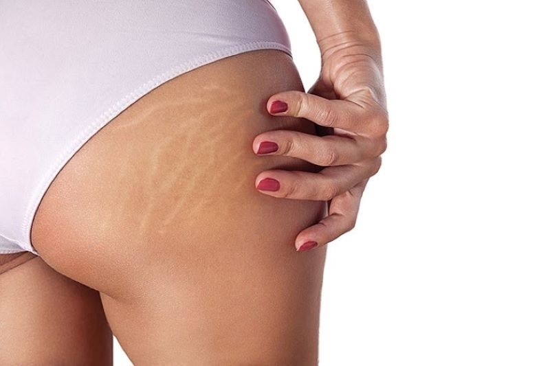 Rạn da xuất hiện ở những vùng da mỏng, chảy xệ do tăng cân đột ngột
