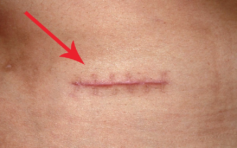 Vết thương lên da non bị thâm là hiện tượng dễ thấy sau phẫu thuật