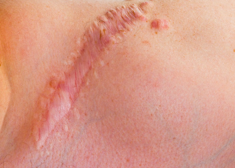 Sau 6 tháng vết thương lên da non bị thâm dễ hình thành sẹo