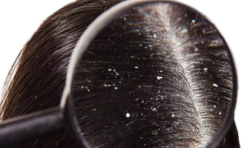 Chăm sóc tóc thường xuyên để ngăn ngừa nguy cơ da đầu hình thành gàu